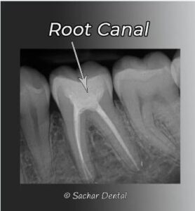 Root Canals