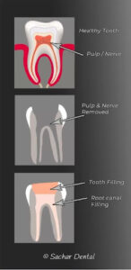 What is a Root Canal?