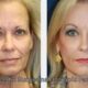 Plastic Surgeons Ozempic Face