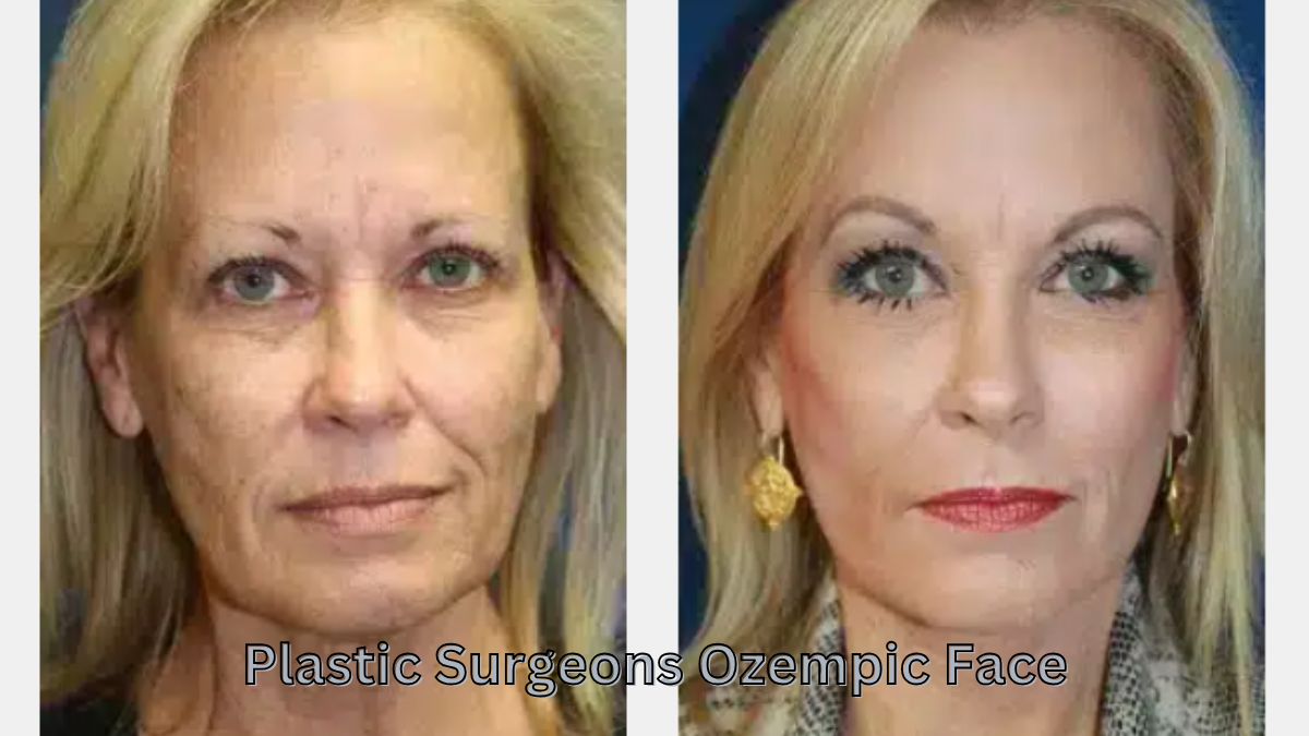 Plastic Surgeons Ozempic Face