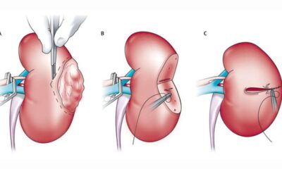 nephrectomy