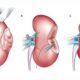 nephrectomy