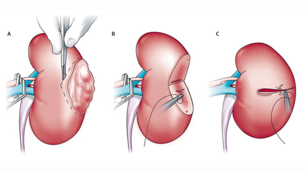 nephrectomy