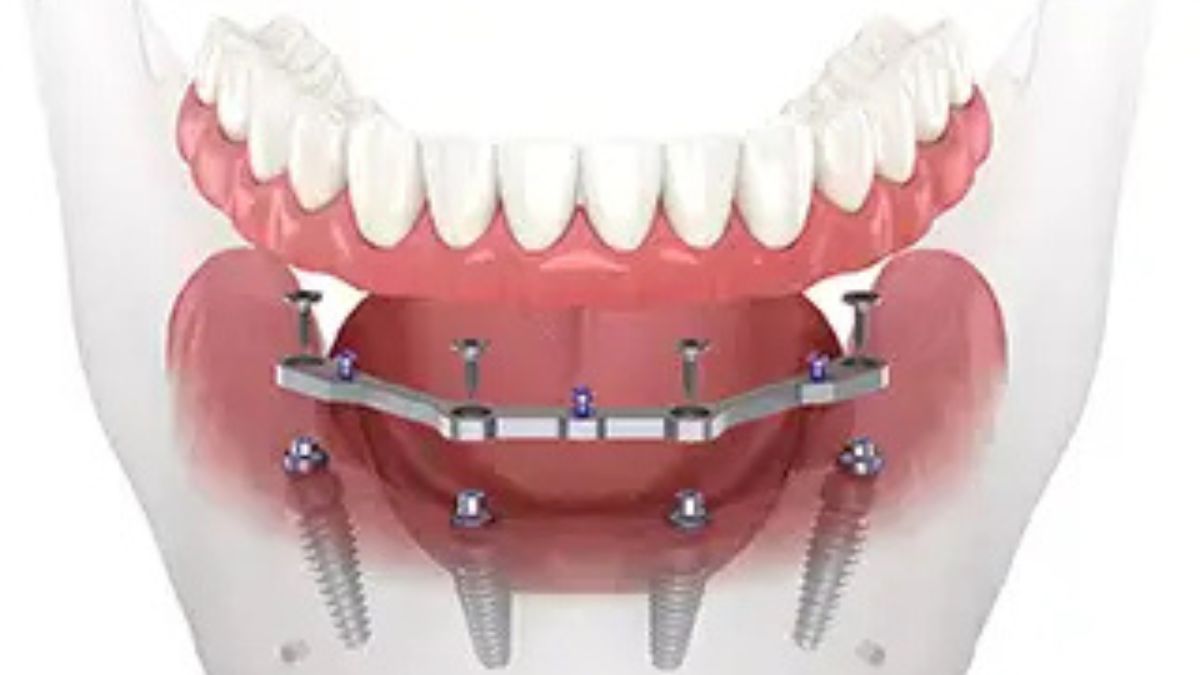 Dental Implants