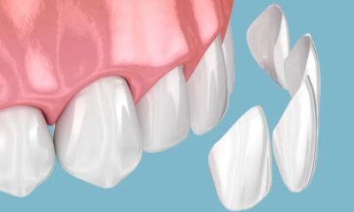 Dental Composites