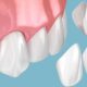 Dental Composites