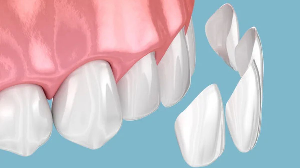Dental Composites