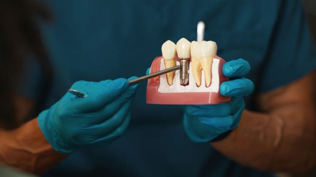 Dental Implant