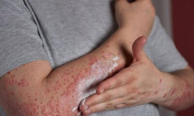 Eczema Treatment