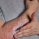 Eczema Treatment