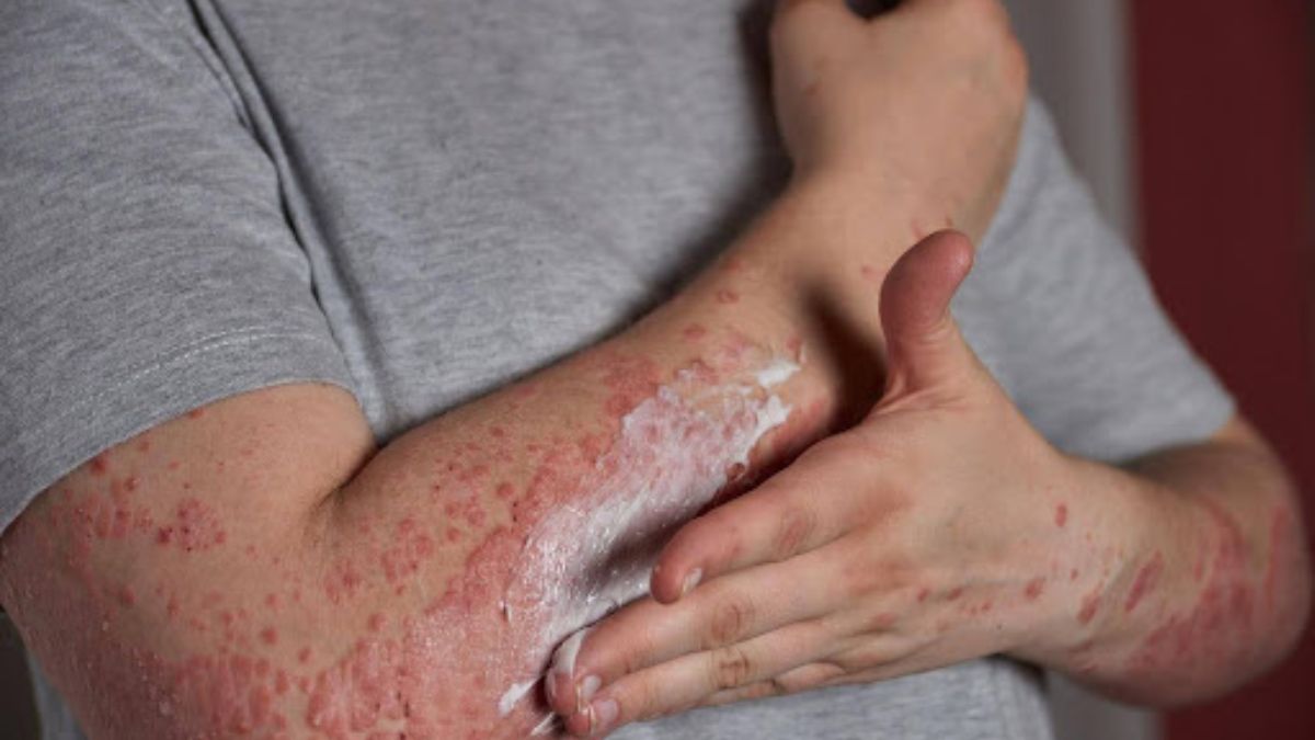 Eczema Treatment