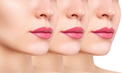 Lip Injections