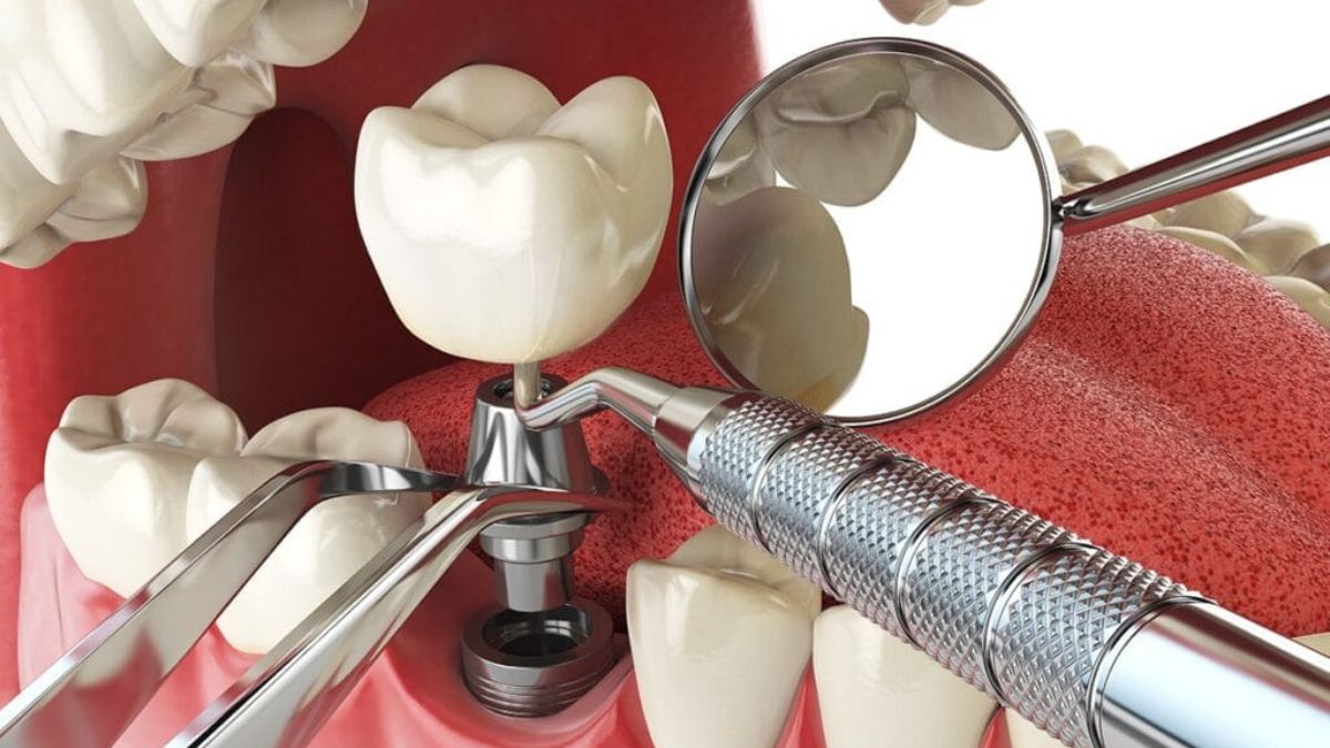 dental implant course